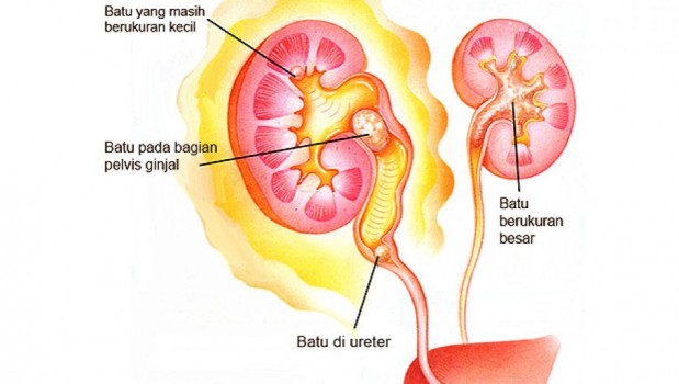 Kenali Gejala Gangguan Batu Ginjal